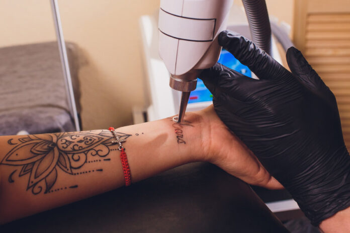 odstranění tetování laserem metoda výřez výbrus kryochirurgie jizva